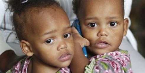 Sijamski blizanci iz Dominikanske Republike