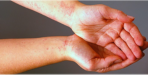 Shvaćanje hereditarnog angioedema: Tajanstveni nekontrolirani imunosni odgovor