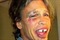 Steven Tyler bez zuba i s licem punim modrica