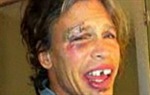 Steven Tyler bez zuba i s licem punim modrica