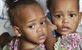 Sijamski blizanci iz Dominikanske Republike