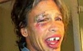 Steven Tyler bez zuba i s licem punim modrica